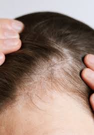 Female Pattern Baldness: Causes, Early Signs & Natural Remedies for Hair Thinning in Women